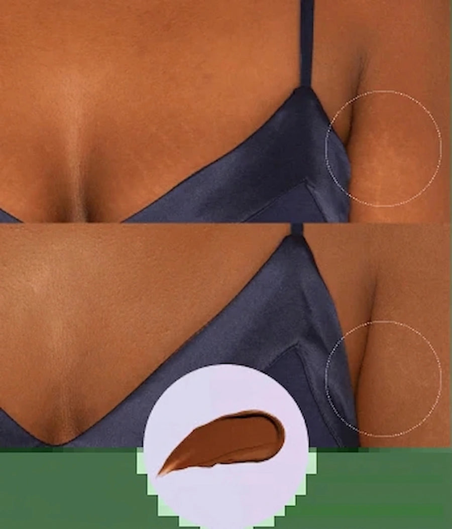 Birthmark